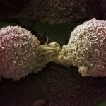 ca de pumón Por LRI EM unit