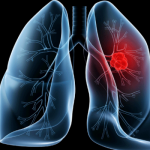 lung-950×400